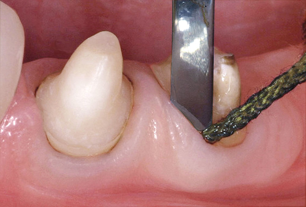 cm0302rapidperfectimpression01