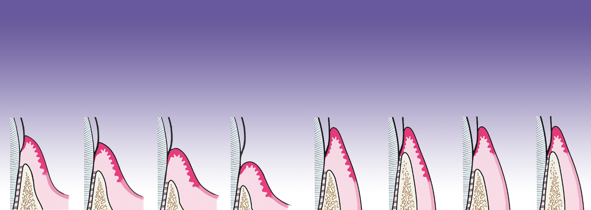 cm0402passiveeruptionhd