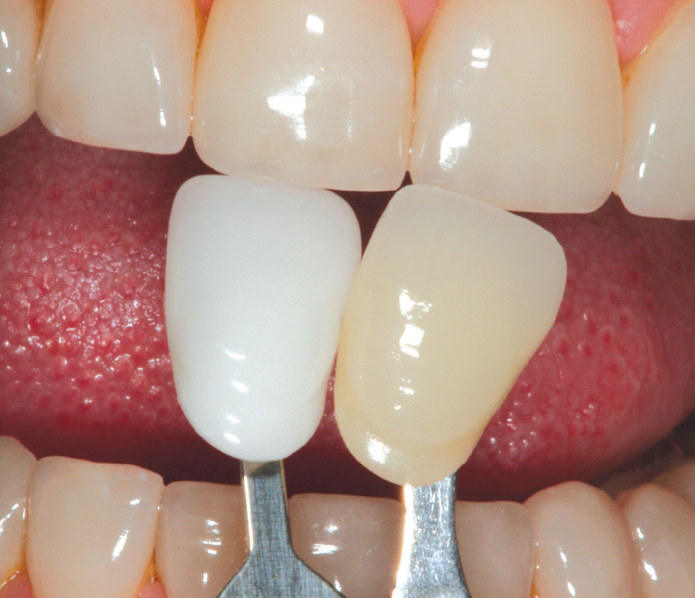 cm0701upgradingporcelainveneerrestorations11