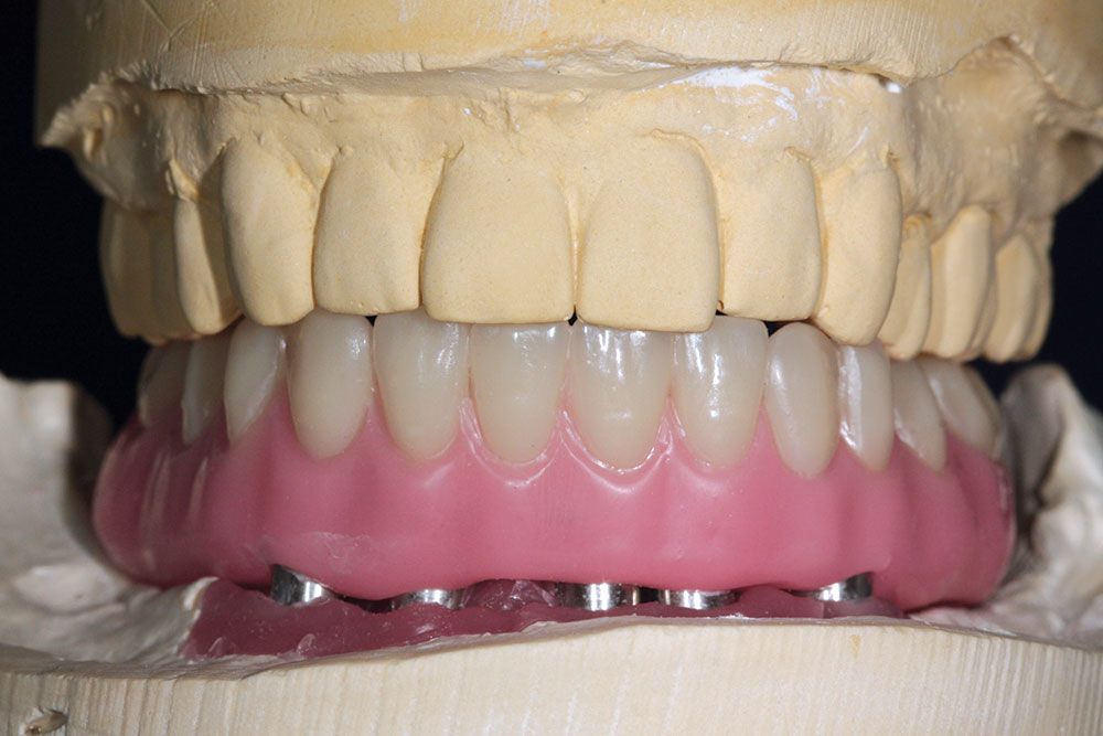 im0101screwretaineddenture23
