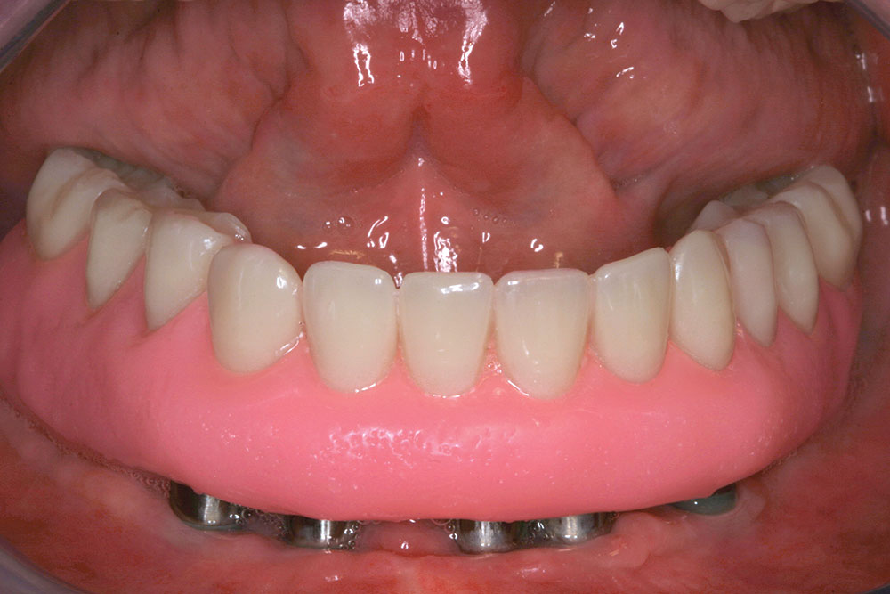 im0101screwretaineddenture38
