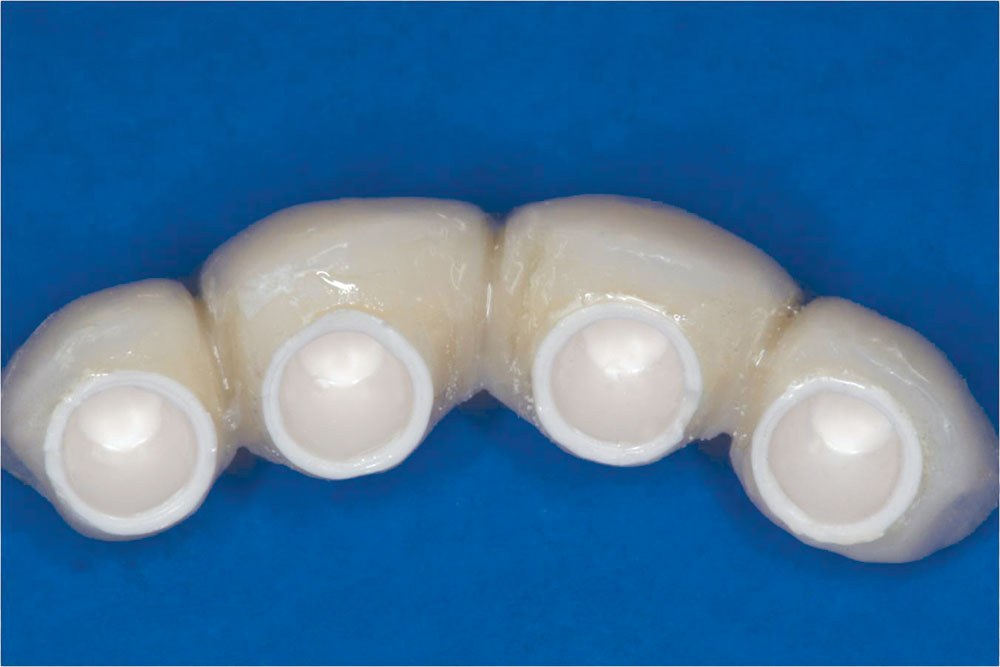 im0102optimizingimplantplacement06