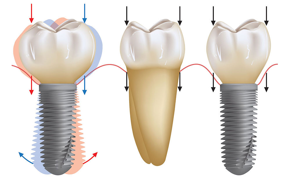 im0402clinicaltipbruxism02