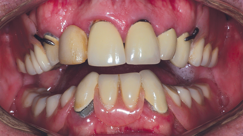 im0701edentulouspatientsnazarian01a