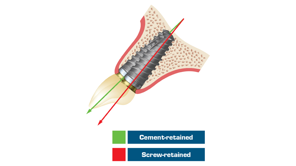 im0704implantocclusion201c1