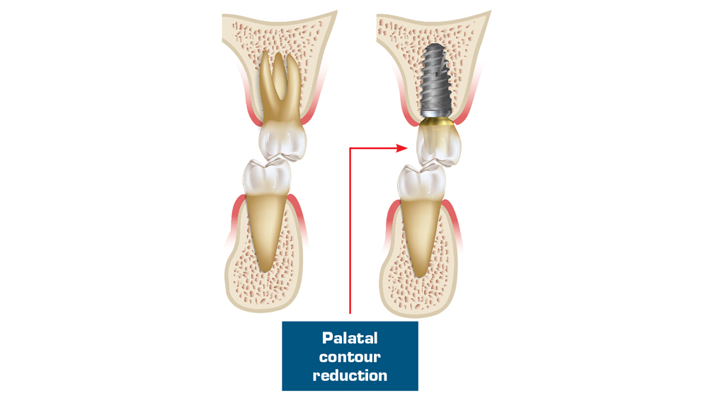 im0704implantocclusion202d1