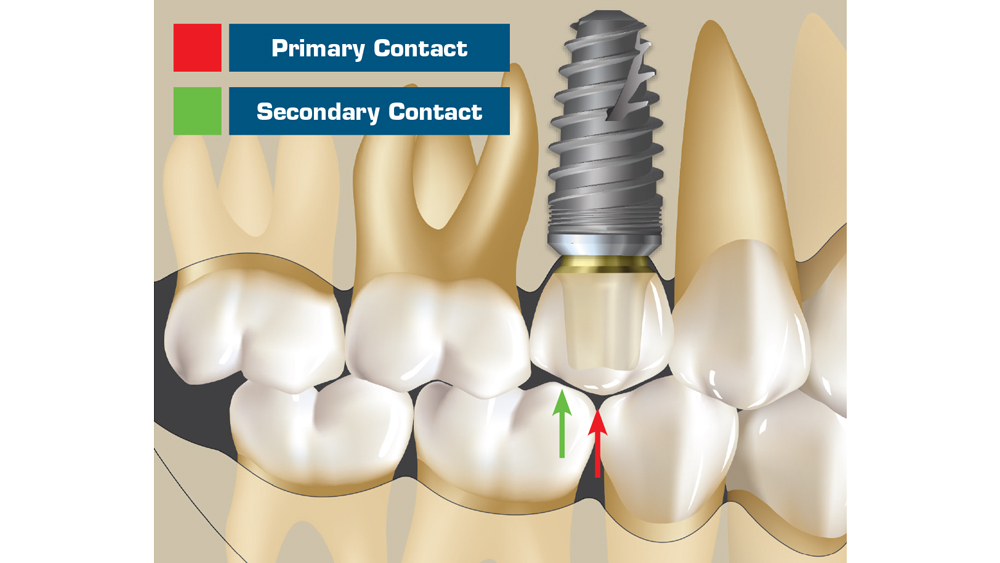 im0704implantocclusion205a1