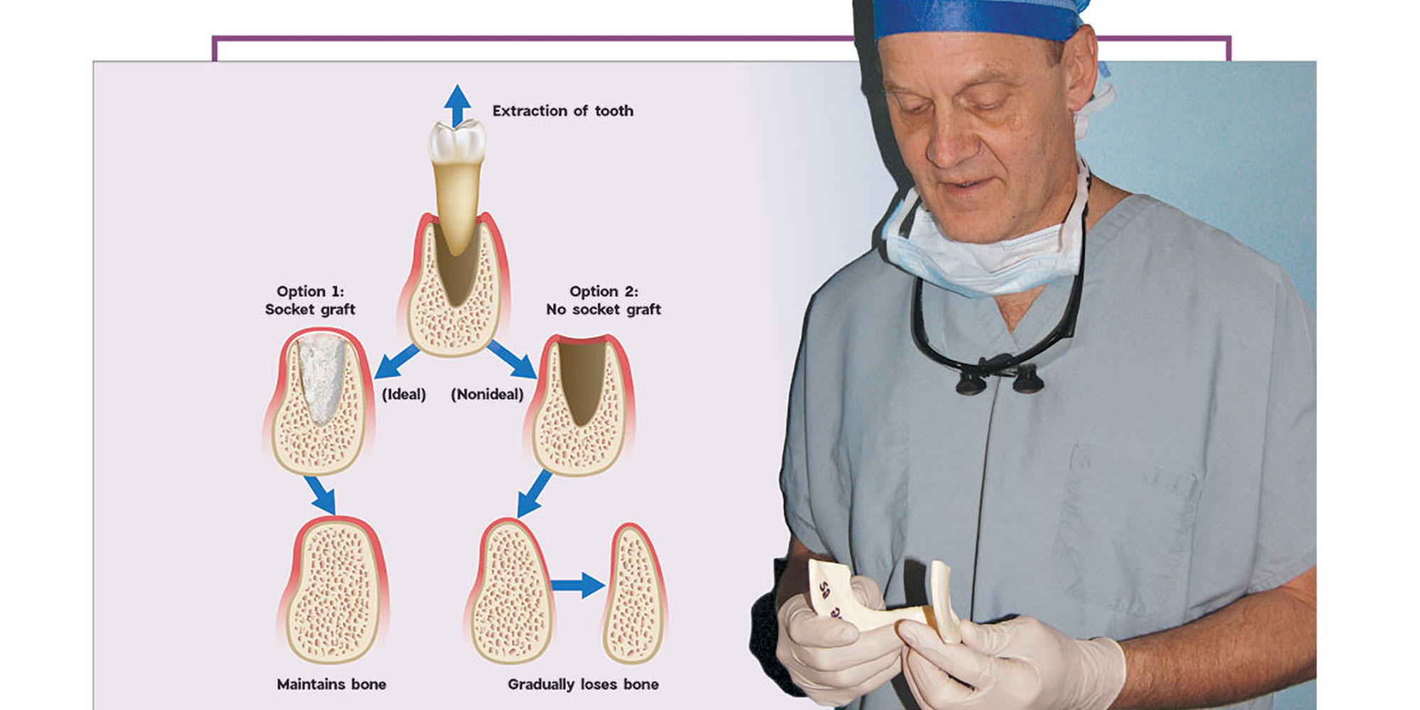 Extraction And Socket Grafting Part 2 Extraction Site Healing